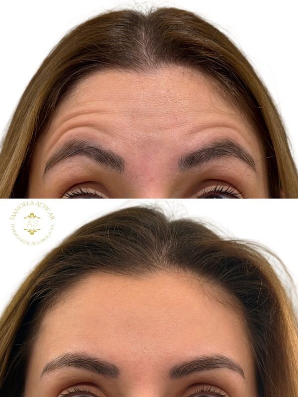 Antes e depois de Botox, caso 1