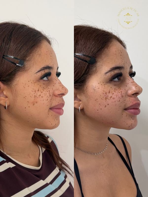 Antes e depois de Full Face, caso 1