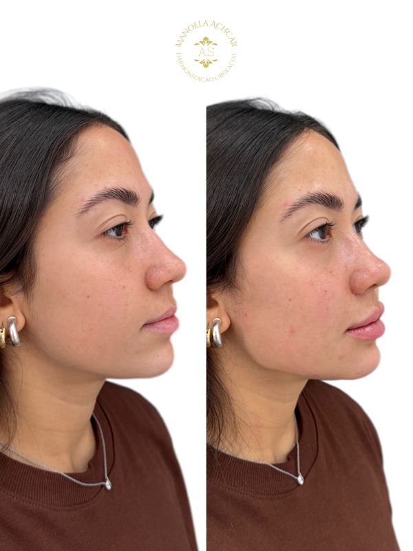 Antes e depois de Perfiloplastia, caso 1
